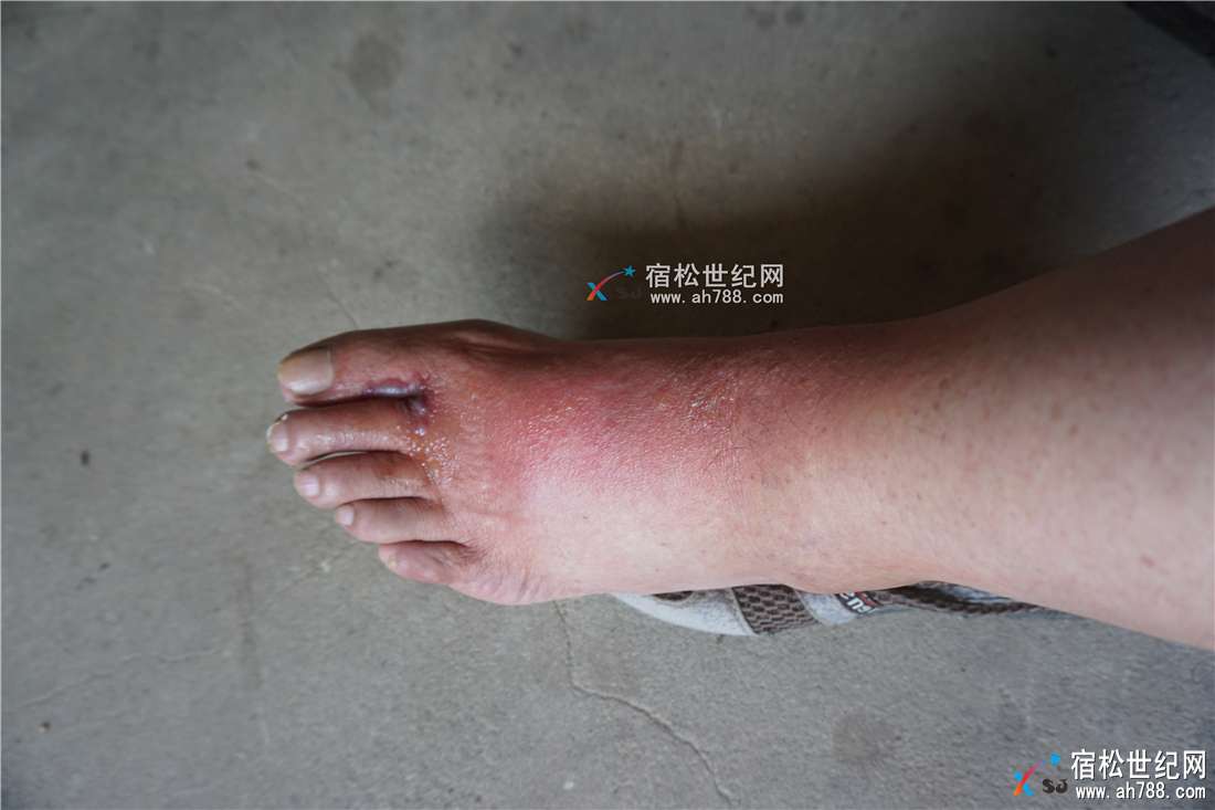 被蜘蛛咬伤脚叉发炎红肿_副本.jpg
